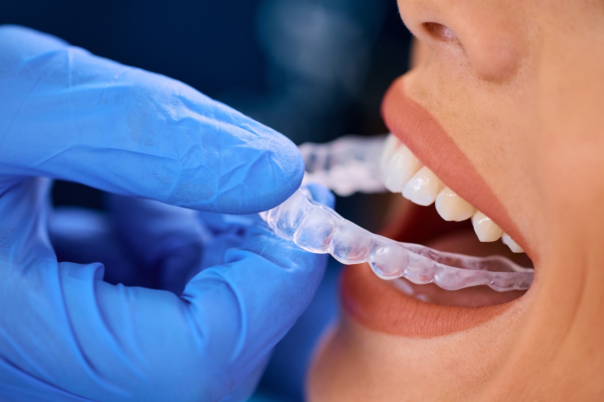 ClearCorrect-Aligners-in-Chicago-Heights